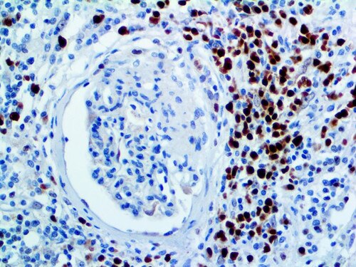 IHC of MUM1 on an FFPE Kidney Tissue